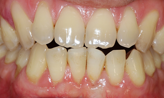 close together teeth treatment in castle hill