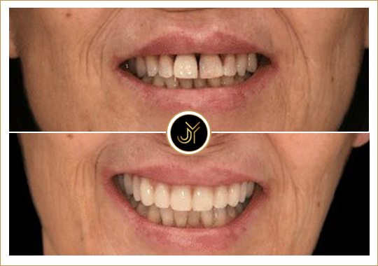 dental implant winston hills