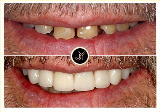 castle hill dental implant services