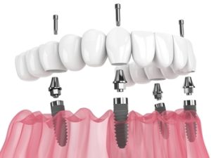Full-Mouth-Dental-Implants-Cost-australia-posts