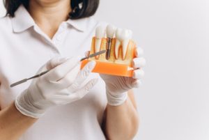 Cost Of Dental Implants In Australia explanation bella vista