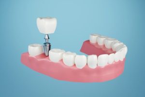 Affordable Dental Implants illustration bella vista