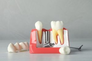 Affordable Dental Implants image bella vista