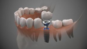 Affordable Dental Implants single bella vista