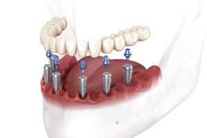 Cost-for-Full-Mouth-Dental-Implants-posts-bella-vista