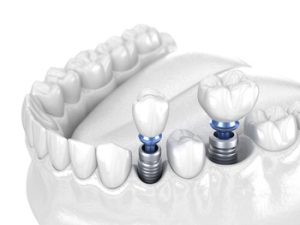 Dental Implant Vietnam types bella vista