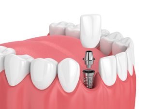 Dental Implants Bangkok procedure bella vista