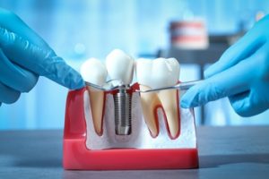  costing for dental implants india bella vista