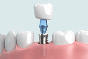 Dental Insurance That Covers Implants placement bella vista