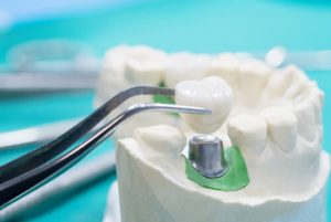 dental implant cost philippines procedure