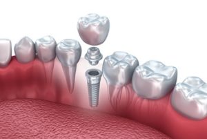 Dental Implant payment plans options