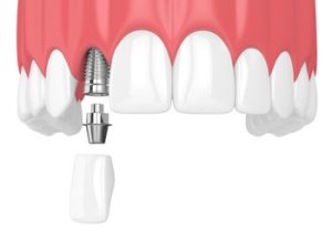 Dental Implants In India illustration