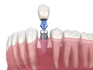 Dental Implants In India single