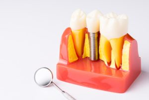 Dental Implants Manila illustration