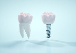 Dental Implants Manila missing tooth