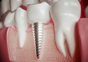 Dental Implants Phuket quality