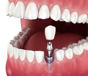 dental implant cost turkey change