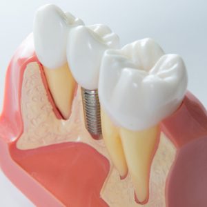 Close,Up,Of,A,Dental,Implant,Model.,Selective,Focus.