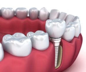 Tooth,Implant,And,Crown,Installation,Process.,Medically,Accurate,3d,Illustration