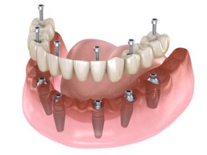 Full Mouth Dental Implants Cost Bali 4 or 6