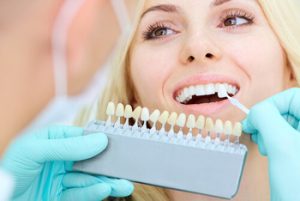 How Much Do Veneers cost in bali colour