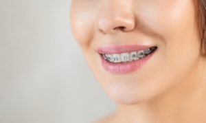 how long do braces take wear