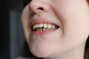 How to Fix Overbite symptoms