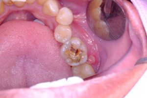 Can Tooth Decay Spread problem