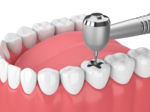 3d,Render,Of,Jaw,With,Teeth,,Dental,Handpiece,And,Drill