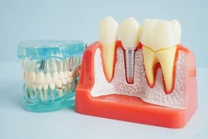 is dental implant safe check