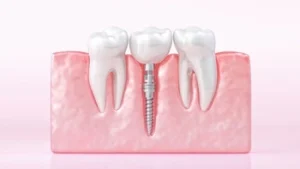 is dental implant safe last
