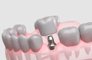 Dental Implant Healing Stages application