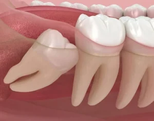 How to fix crooked teeth impacted